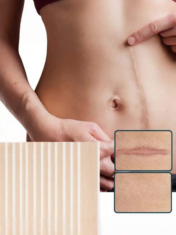 Silicone Scar Covering Tape - Gentle, Washable, And Reusable For Surgical Scars, C-Section Scars, And Keloid Scars - Soft, Breathable, And Water-Resistant Silicone Scar Sheets For Effective Scar Management
