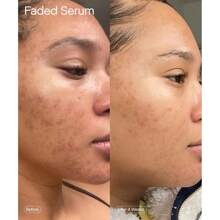 Faded Brightening And Clearing Serum | Reduces Discoloration Post-Blemish Marks Scars Spots Contains Kojic Acid Niacinamide Dermatologist-Tested Vegan Cruelty-Free Fl Oz