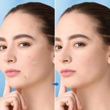 720 parches para acné y granos - Sin alcohol, sin parabenos, sin fragancias, parche limpiador de poros con adhesivo fuerte, apto para todos los tonos de piel clara, incluyendo piel sensible