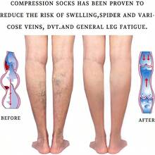 Performance 1520 MmHg Medical Compression Stockings For Women And Men Thigh High DotTop Open Toe Socks For Varicose Vein Swollen Legs Travel Flight Pregnant BeigeL - 米色+中號 - 查看 4