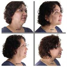 QY Instant Neck Lift Tape 30 Day Supply Transparent Neck Lifting Anti Wrinkle Stickers Tones Sagging Necklines Instantly Made In USA  1613 - 如圖 - 查看 2