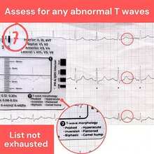 NetHong ECG/EKG 7 Step Ruler Card For ECG/EKG Interpretation Portable ECG EKG Card Ruler - Transparent - View 4