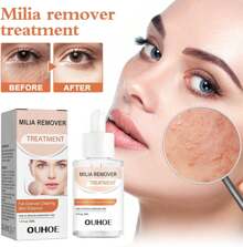 Anloximt 去除粟丘疹 30 毫升保湿粟丘疹去除剂脂肪颗粒修复粟丘疹去除眼下有助于溶解和减少眼周粟丘疹，学校背包