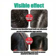 6pcs Lice Comb Set - Easy Lice & Nit Removal, Long-Lasting Undistorted Anti-Dandruff Comb