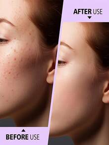 2件/4件装不锈钢双头黑头导出工具 - 专业双头导出器，符合人体工学的手柄，适用于挤压白头、黑头、粉刺和面部清洁。无需电池，便携式设计，耐用材质，易于清洁，是美容爱好者的必备品，专为护肤而设计。 - 銀色 - 查看 6