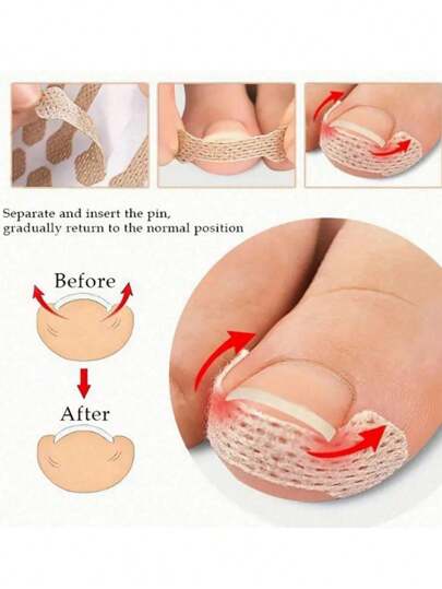 10/20/30/40/50/60/70/80/90/100 szt./zestaw plastrów korygujących wrastające paznokcie u stóp, bezbolesna poprawa stanu paznokci u stóp, korektor paznokci u stóp odpowiedni do różnych rodzajów pielęgnacji stóp