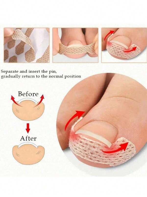 Set de 10/20/30/40/50/60/70/80/90/100 parches correctores para uñas encarnadas, mejora indolora para problemas de uñas encarnadas, corrector de uñas adecuado para diversos tipos de cuidado de los pies
