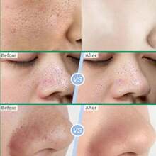 Pore Cleansing Cream - Minimizes Pores, Removes Blackheads, Treats Acne, Brightens Skin, Moisturizes And Smoothens Skin, Skincare