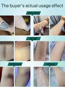 Silicone Scar Sheets - Gentle, Washable, Reusable, Suitable For Surgical Scars, C-Section Scars And Keloid Scars - Soft, Breathable, Waterproof Silicone Scar Sheets, Effective Scar Management