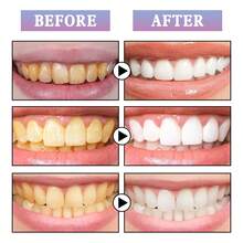 2pcs Teeth Whitening Pen,Tooth Whitening Gel,Travel Suit Tooth Bleach Gel,Stains Personal Oral Hygiene,Gift For Women,Girl And Parents - 紫色 - 查看 3