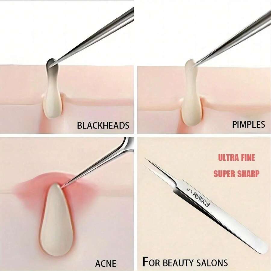 Stainless Steel Acne Needle With Precise Tip Design. Double-Ended Acne Removal Tool With Ring End + Hook End. Precise Cleaning Of Blackheads/Whiteheads/Closed Pores. Same As Beauty Salon Products. Dermatologist Recommended Exfoliation Care. Ergonomic Non-Slip Handle. Long-Lasting Corrosion Resistance And Easy To Disinfect. Suitable For Sensitive Skin Without Damaging Pores. Must-Have For First Aid Of Acne-Prone Skin. Home Beauty Care - Bạc - Xem 1