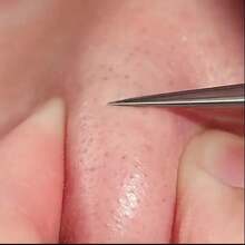 Stainless Steel Acne Needle With Precise Tip Design. Double-Ended Acne Removal Tool With Ring End + Hook End. Precise Cleaning Of Blackheads/Whiteheads/Closed Pores. Same As Beauty Salon Products. Dermatologist Recommended Exfoliation Care. Ergonomic Non-Slip Handle. Long-Lasting Corrosion Resistance And Easy To Disinfect. Suitable For Sensitive Skin Without Damaging Pores. Must-Have For First Aid Of Acne-Prone Skin. Home Beauty Care - Bạc - Xem 2