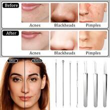 Loại bỏ mụn đầu đen ở mũi, Bộ dụng cụ loại bỏ mụn đầu đen 2025, Dụng cụ nặn mụn chất lượng cao, Nhíp loại bỏ mụn đầu đen có hộp, Dùng để loại bỏ mụn, Phù hợp cho cả nam và nữ. Hộp đựng bộ dụng cụ làm sạch da mặt, Dụng cụ thiết yếu cho việc chăm sóc da và trang điểm, Quà tặng đầu năm học, Quà tặng Giáng sinh. - Nhiều màu - Xem 6
