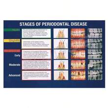 1 pieza Póster educativo de tela para clínica dental, impresión de arte de pared sin marco, etapas de la enfermedad periodontal, orientación vertical, forma rectangular, 12x18 pulgadas/30x45 cm, para decoración de sala de estar y dormitorio