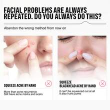 3Pcs/Set Stainless Steel Acne Clip Set Comedones Extractor Acne Removal Kit For Travel Or On-The-Go Touch-Ups,Blackhead Remover,Beauty,Skin Care Products,Spa,Self Care,Skin Care Tools,Face Care,Esthetician Supplies,Skin,Face Wash,Facial