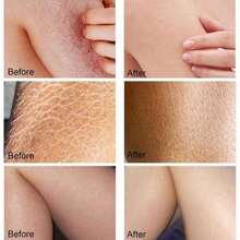 ARCHIDATE Strawberry Leg Cream, Rough And Bumpy Skin Cream, Fade Strawberry Spots, Nourish &Amp; Moisturize Dry Skin, Smoothing &Amp; Buffing Body Scrub Exfoliator - trắng - Xem 6