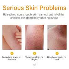 ARCHIDATE Strawberry Leg Cream, Rough And Bumpy Skin Cream, Fade Strawberry Spots, Nourish &Amp; Moisturize Dry Skin, Smoothing &Amp; Buffing Body Scrub Exfoliator - trắng - Xem 2