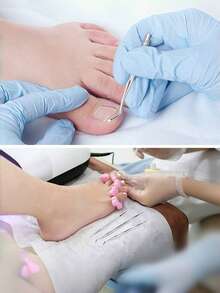 Zestaw 3 narzędzi do pielęgnacji wrastających paznokci u stóp, narzędzia do pedicure dla stóp, w tym podnośnik do paznokci u stóp i pilnik do paznokci u stóp, odpowiedni do leczenia wrastających paznokci u stóp - stal nierdzewna klasy medycznej, narzędzie do czyszczenia paznokci i pedicure, narzędzie do pielęgnacji paznokci u stóp - w zestawie pudełko do przechowywania