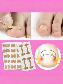 Zestaw do leczenia wrastających paznokci u stóp, zestaw narzędzi do usuwania wrastających paznokci u stóp, korektor wrastających paznokci u stóp, plaster korygujący do paznokci u stóp, paski korygujące do paznokci u stóp, zestaw narzędzi do pedicure z pilnikiem do podnoszenia paznokci u stóp