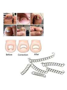 Zestaw do leczenia wrastających paznokci u stóp, zestaw narzędzi do usuwania wrastających paznokci u stóp, korektor wrastających paznokci u stóp, plaster korygujący do paznokci u stóp, paski korygujące do paznokci u stóp, zestaw narzędzi do pedicure z pilnikiem do podnoszenia paznokci u stóp