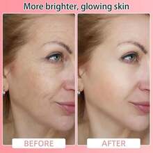 Micro Infusion For Skin Care,Micro Infusions System For Taking Care Of Blemished Skin For All Types (6+2) - trắng - Xem 5