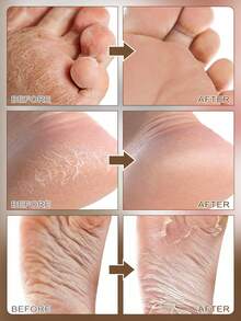 5 Pairs Foot Peel Mask For Dry Cracked Feet – Peeling Mask Removes Dead Skin And Calluses - Coconut Exfoliating For Soft Feet, Repair Rough Heels Soft Smooth Touch Spa Experience At Home