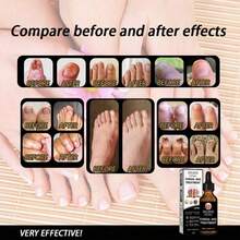 Nail Fungals Treatment Strength Nail Repair Thick Cracked Discolored Nails Toenail & Fingernail Care Solution Restore Healthy Nails 30ml White Golden - 預設 - 查看 7