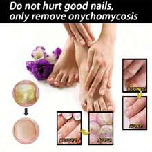 Feet Care Essence For Nail Fungal Treatment Feet Care Repair Moisturizing Nail Anti Infection Care Liquid Obat Kuku Yang Rusak - Mặc định - Xem 6