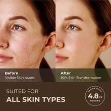 Gya Labs Australian Tea Tree Essential Oil For Skin 0.34 Fl Oz 100% Pure Natural Melaleuca Tea Tree Oil For Hair Face And Toenail Piercings Scalp And Candle Making Scent