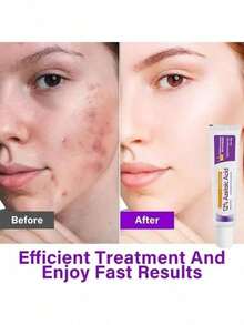 Crema de ácido azelaico, 1 suero de ácido azelaico al 12% con ácido hialurónico y niacinamida, gel de ácido azelaico para reducir las imperfecciones y el acné rosácea, humecta y equilibra el sebo. - Morado - Ver 4