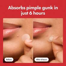 ™ Original Patch From Hero Cosmetics – The #1 Hydrocolloid Acne Pimple Patch For Shrinking Zits And Whiteheads In 1 Use; Nighttime Spot Stickers For Face And Skin (36 Count) - 紅白色 - 查看 4