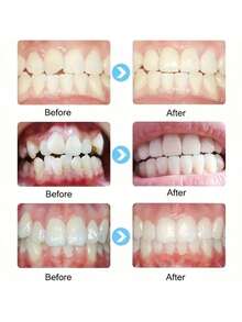Joyería dental de estilo simple y neutro, adecuada para uso diario, vacaciones, fiestas, casual, maquillaje de vacaciones, estilo hip-hop. Accesorios dentales con rhinestones - Blanco - Ver 4