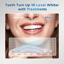Fairywill Teeth Whitening Kit For Sensitive Teeth-1Pcs 28LED Teeth Whitening Light-3Pcs Teeth Whitening Gel -10 Min Fast Teeth Whitener- Enamel Restores Your Gleaming White Smile - Xanh và trắng - Xem 3