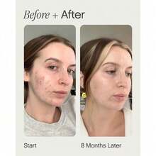 Faded Brightening And Clearing Serum | Reduces Discoloration Post-Blemish Marks Scars Spots Contains Kojic Acid Niacinamide Dermatologist-Tested Vegan Cruelty-Free - 藕粉色 - 查看 4