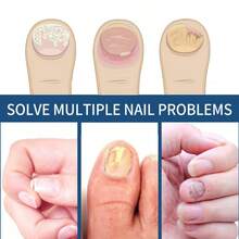 Fungal Nail Patches, 21pcs/Box Nail Health Care Patches, Nail Fungus Care Patches, Suitable For Solving Fungal Nails And Other Nail Problems, Nail Supplies, Daily Care Nails Kit Set Manicure Comfort - 杏色 - 查看 2
