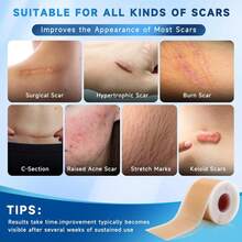 Silicone Scar Sheets, Silicone Scar Tape(1.6" X 120" Roll 3M), Silicone Scar Sheets For  Scars, Keloid Bump Removal, Stretch Marks Removal, C-Section, Burn Et