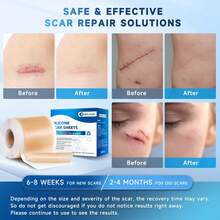 Silicone Scar Sheets, Silicone Scar Tape(1.6" X 120" Roll 3M), Silicone Scar Sheets For  Scars, Keloid Bump Removal, Stretch Marks Removal, C-Section, Burn Et