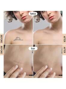 硅胶疤痕贴 - 温和、可水洗、可重复使用，适用于手术疤痕、剖腹产疤痕和瘢痕疙瘩 - 柔软、透气、防水的硅胶疤痕贴，有效护理疤痕 - 彩色 - 查看 5