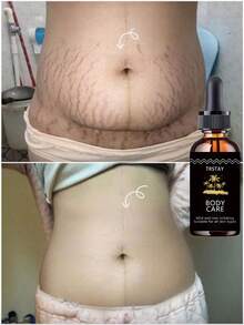 Fading Lines, Moisturizing Oil, Softening And Moisturizing The Dry And Cracked Abdominal Muscles, Repairing Stretch Marks, Rough Texture, And Rough Touch - 彩色 - 查看 1
