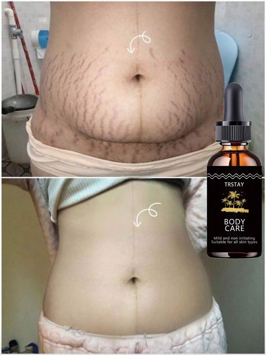 Fading Lines, Moisturizing Oil, Softening And Moisturizing The Dry And Cracked Abdominal Muscles, Repairing Stretch Marks, Rough Texture, And Rough Touch - 彩色 - 查看 1