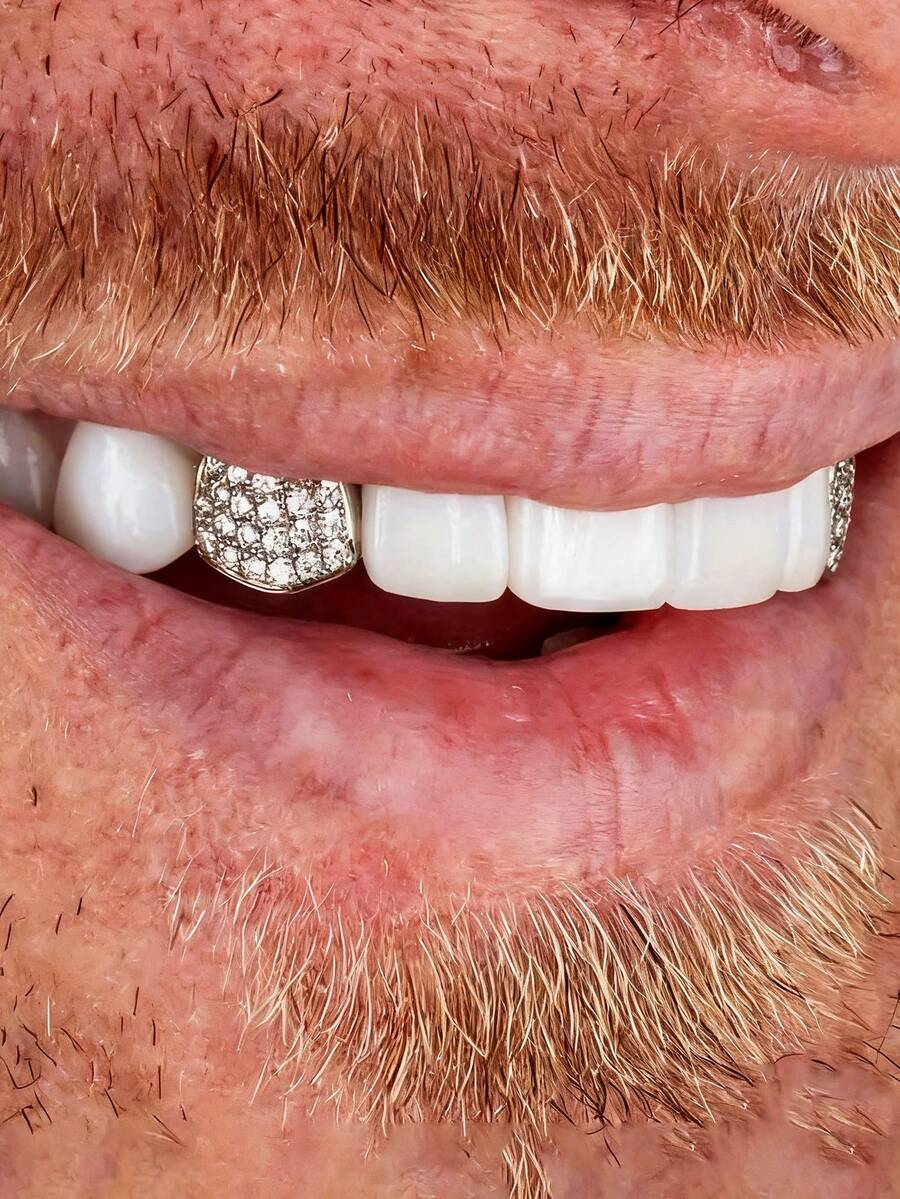 2pcs Hip Hop Style Men's Glitter Tooth Grillz, Popular Accessory For Men At Parties And Music Festivals - Single Braces - View 1