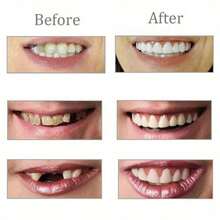 2 件/套全新升级无孔上下牙齿矫正器，模拟假牙，完美微笑牙齿装饰 - 彩色 - 查看 2