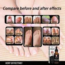 Feet Care Essence Nail Fungal Treatment Feet Care Repair Moisturizing Nail Anti Care Obat Kuku Yang Rusak