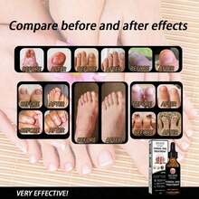 Feet Care Essence Nail Fungal Treatment Feet Care Repair Moisturizing Nail Anti Care Obat Kuku Yang Rusak