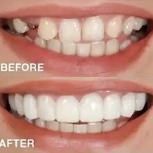 4 piezas Kit de decoración para blanqueamiento de dientes con sonrisa, 2da generación, fácil de usar