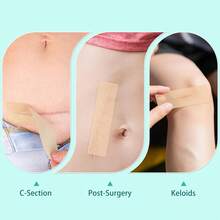Silicone Scar Tape 6 Sheets - Grade Scar Tape Surgical Scars, Reusable Silicone Scar Sheets C-Section, Surgery, Keloid Scars & Acne Scars - 1.6"X 5.9" - 1 - 查看 5