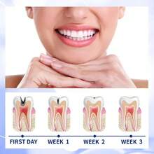 New Tooth Decay Prevention Toothpaste Effective Treatment Decayed Tooth Whitening Toothpaste Removal Yellow Toothpaste TeethCare - 1pcs - View 4
