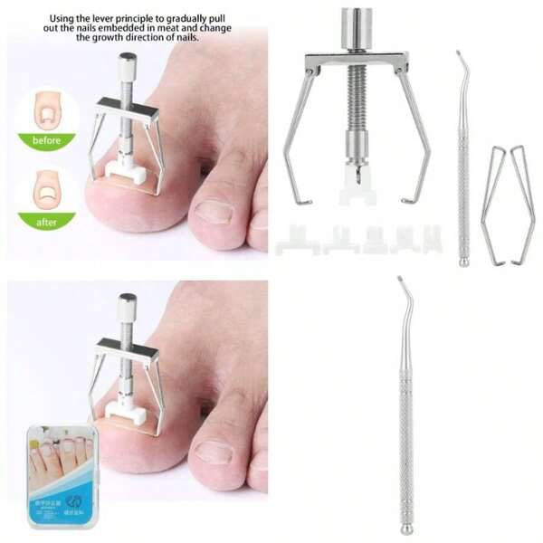 Herramienta De Ua Encarnada, Trimmer Profesional Alicates Uas Encarnadas, Tratamiento De Uas Fijacin De Ua Encarnada, Corrector De Paroniquia De Uas, Conjunto De He