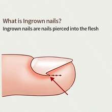 （50+2 包嵌甲矫正治疗套装，50 片嵌甲矫正贴片，嵌甲修脚工具，嵌甲矫正贴片，含 2 个嵌甲提拉器和锉刀）