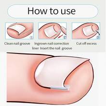 （50+2 包嵌甲矫正治疗套装，50 片嵌甲矫正贴片，嵌甲修脚工具，嵌甲矫正贴片，含 2 个嵌甲提拉器和锉刀）